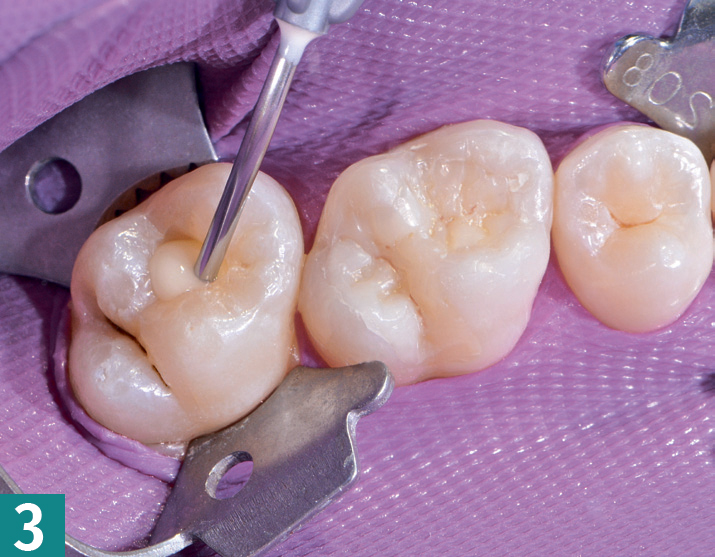 Реставрация DMG Constic - этап 3